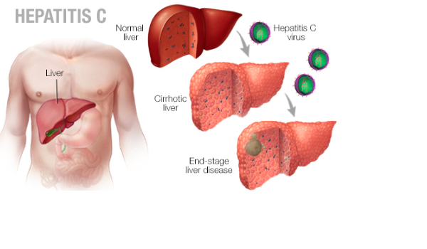 Everything you need to know about hepatitis C