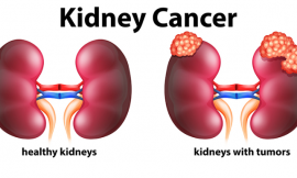 Kidney Cancer – Symptoms, Causes And Prevention