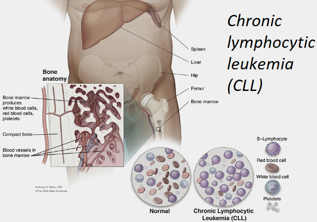 Chronic Lymphocytic Leukemia – Symptoms, Causes and Treatment