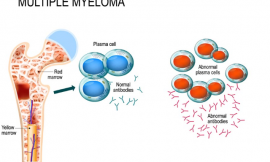 Multiple Myeloma – Symptoms,Causes and Treatment