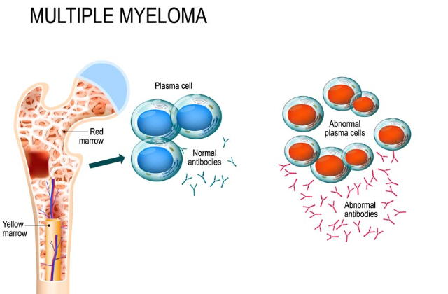 Multiple Myeloma – Symptoms,Causes and Treatment
